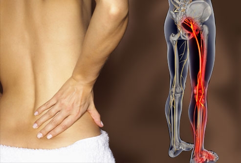 Solutions for Sciatica