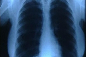 12 chest x ray