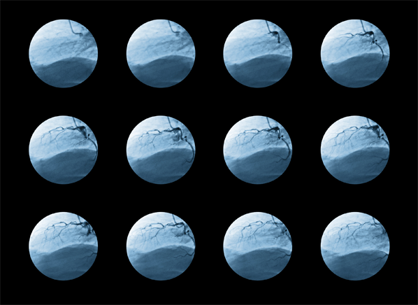 7 Coronary Angiography