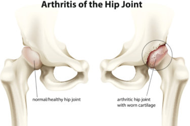 7 ways to treat hip arthritis