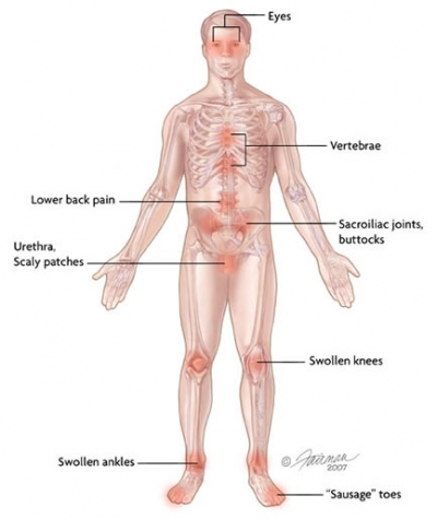 This figure shows the areas of the body that reactive arthritis might affect.
