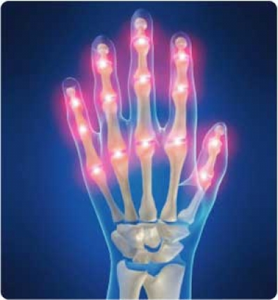 Rheumatoid Arthritis